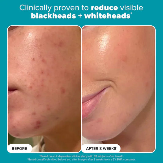 Paula’s choice Skin Perfecting 2% BHA Exfoliating Toner for Clear Skin