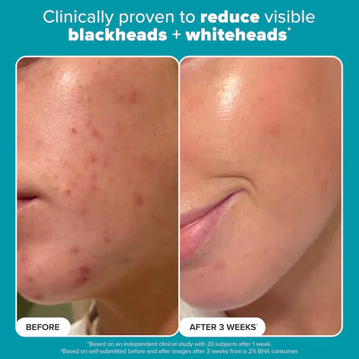 Paula’s choice Skin Perfecting 2% BHA Exfoliating Toner for Clear Skin