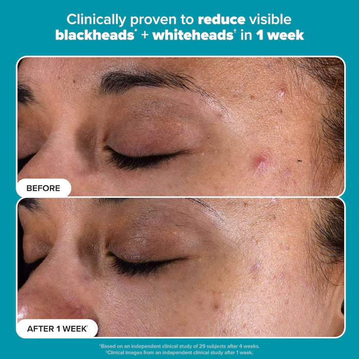 Paula’s choice Skin Perfecting 2% BHA Exfoliating Toner for Clear Skin